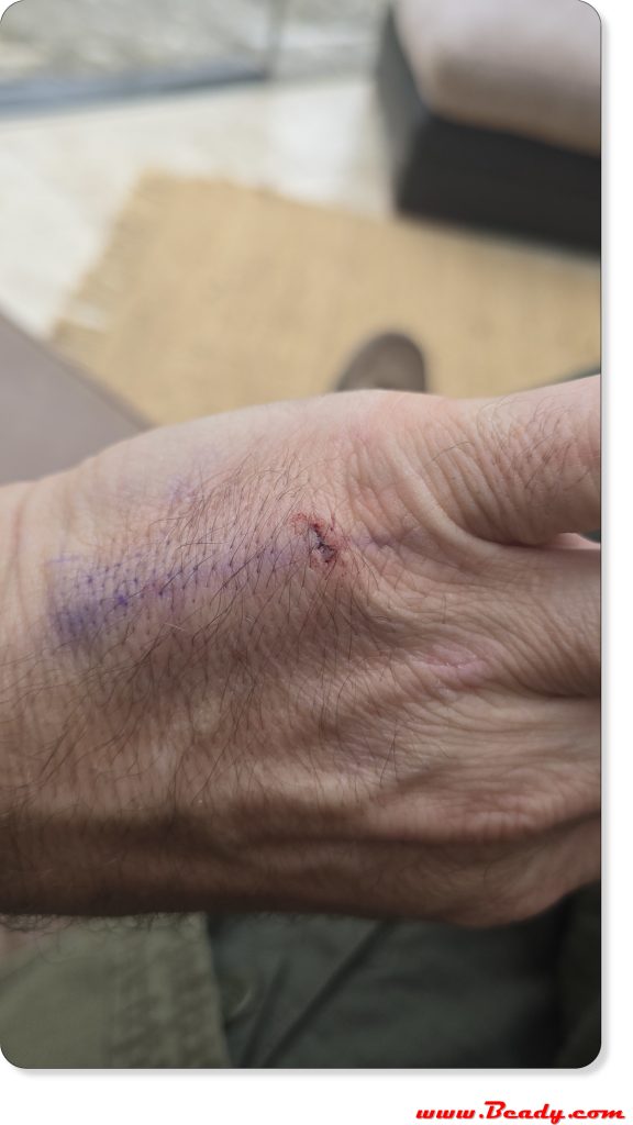 nothing to see here hand has barely a scratch on it after the implant